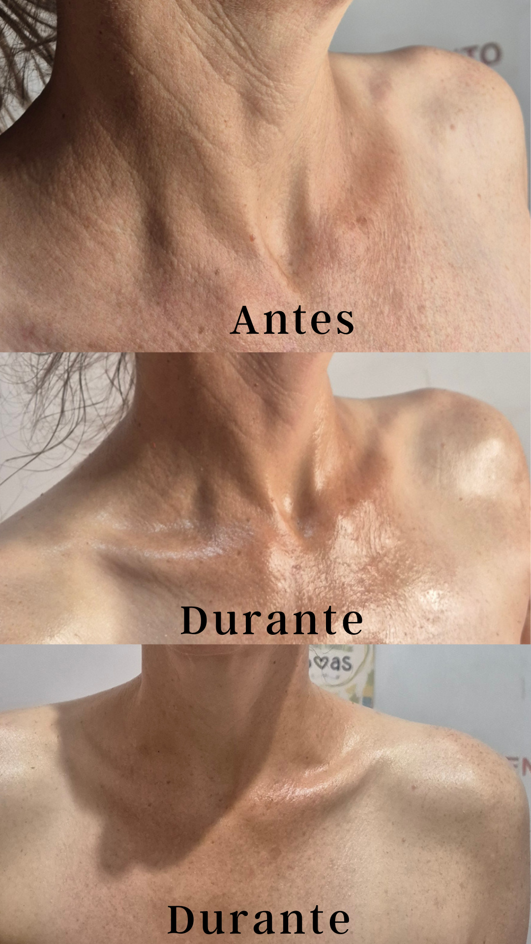 Antes e durante — colo e pescoço