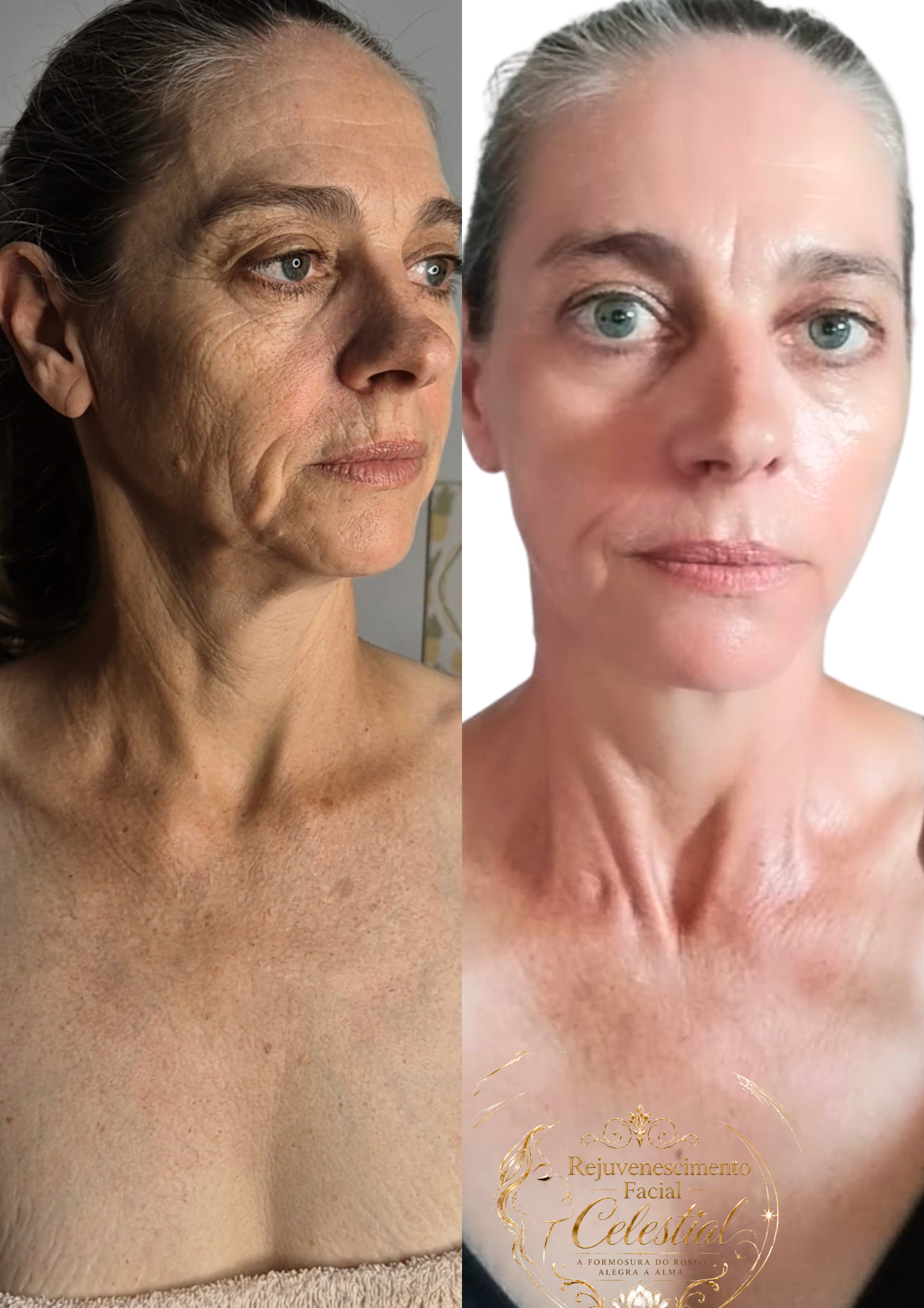 Resultado real — rejuvenescimento facial natural
