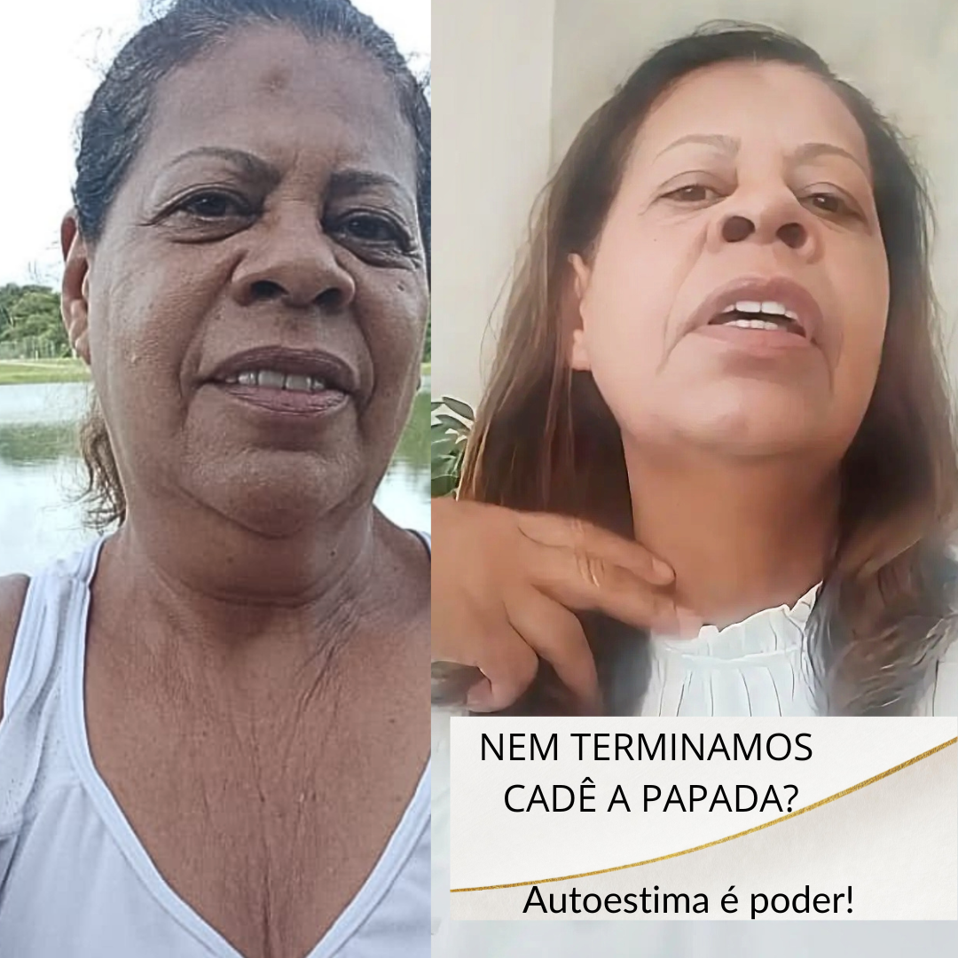 Antes e depois com redução visível da papada e mais definição no pescoço