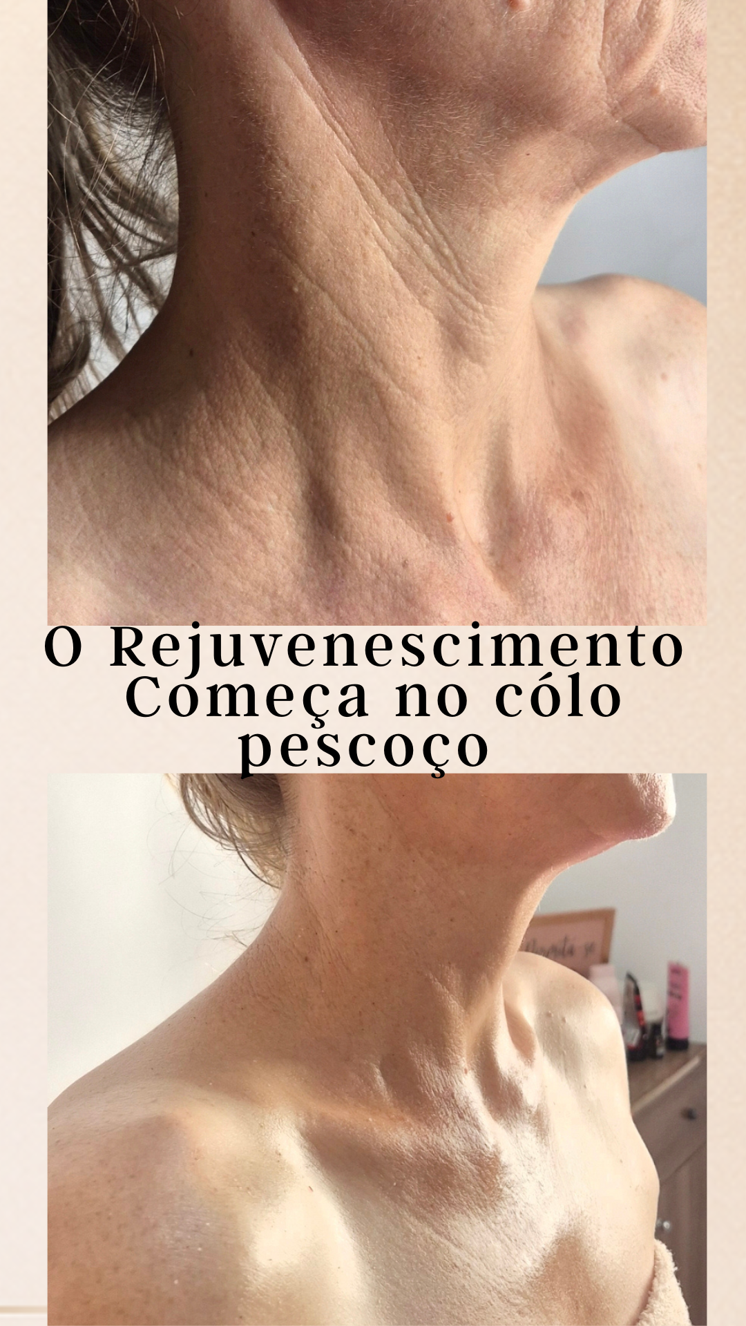 Rejuvenescimento começa no colo e pescoço